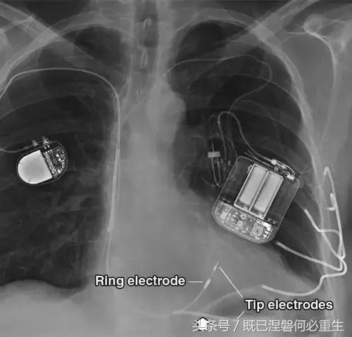 心内除颤仪和起搏器有什么区别,起搏器除颤仪