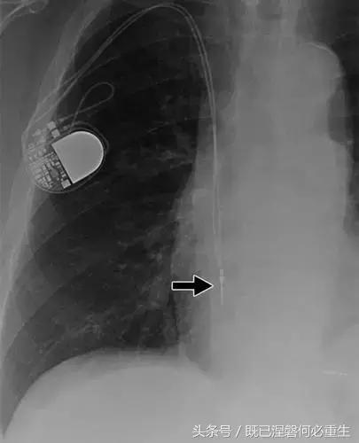 心内除颤仪和起搏器有什么区别,起搏器除颤仪