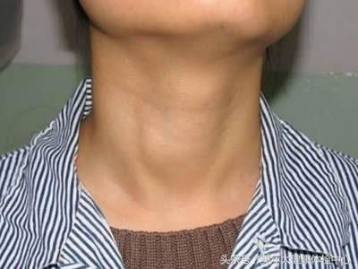 甲亢患者一生气就难受,甲亢两年患者又开始心慌