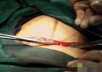 产妇剖腹产未满月，刀疤突然崩裂，医生当场发飙怒骂老公不是东西