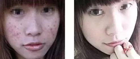 痘印去不掉？看完这篇价值一万块的痘印自救指南，你就会找到答案