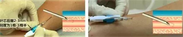 留置针断裂如何发现,留置针断裂入血管的处理方法