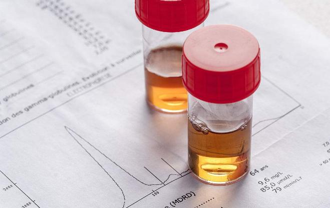 肾病尿蛋白的最佳治疗方案,尿蛋白1尿隐血3肾功能正常严重吗