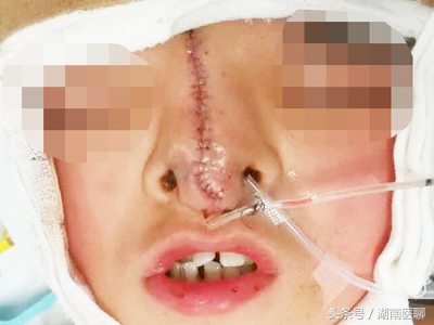 12岁小孩因长相太怪无法入学，尝试整形手术成功，父母热泪盈眶！