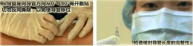 留置针断裂如何发现,留置针断裂入血管的处理方法