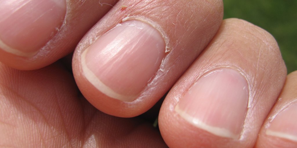 指甲有月牙是肝不好,有个指甲有棱角跟肝有问题吗