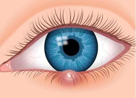 眼皮起麦粒肿什么病引起的,右眼长了麦粒肿有什么征兆