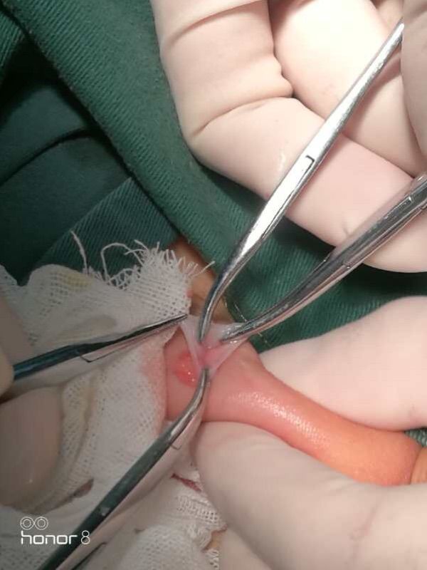 西乡县县医院小儿疝气手术,太和医院疝气微创手术