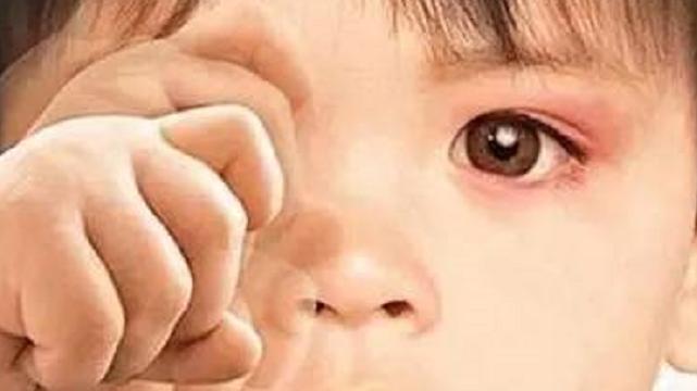 眼皮起麦粒肿什么病引起的,右眼长了麦粒肿有什么征兆