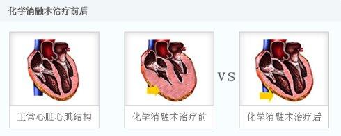 心脏扩大了现在又不大了,心脏增大不管它会怎样