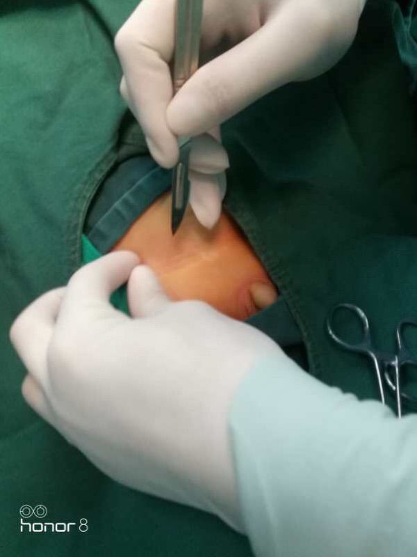 西乡县县医院小儿疝气手术,太和医院疝气微创手术