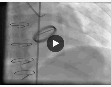 服用华法林患者出现脾脏梗死,服用华法林的案例