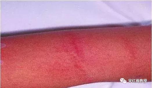 猩红热要注意什么,猩红热一般是怎么得的