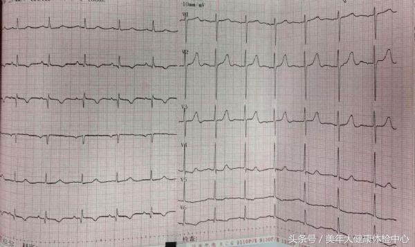 服用华法林患者出现脾脏梗死,服用华法林的案例