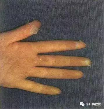 猩红热要注意什么,猩红热一般是怎么得的