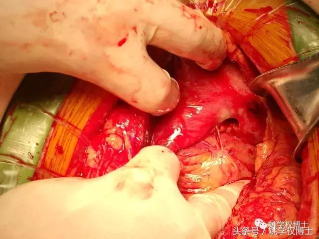 胃癌腐烂,胃癌变硬如何处理