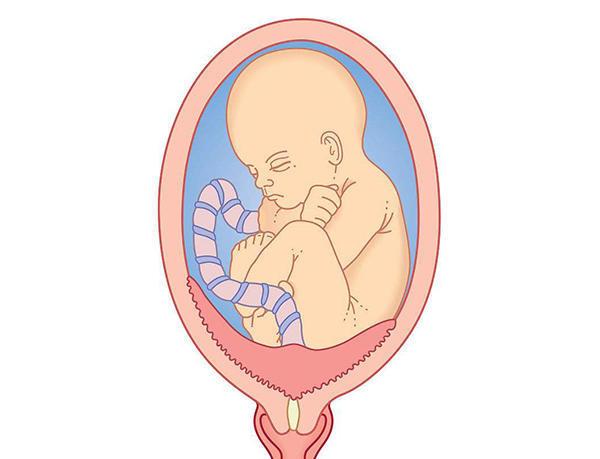 孕早期胎盘前置怎么办,孕中期前置胎盘孕妇注意事项