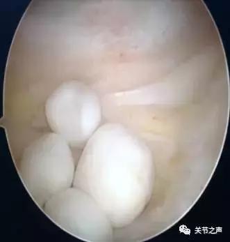 关节腔里长珍珠,关节附近长珍珠