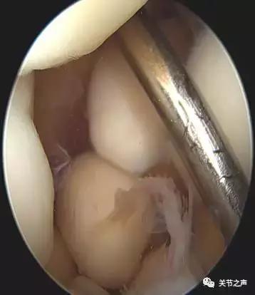 关节腔里长珍珠,关节附近长珍珠