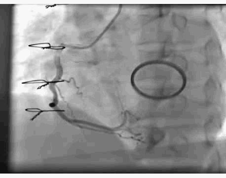 服用华法林患者出现脾脏梗死,服用华法林的案例