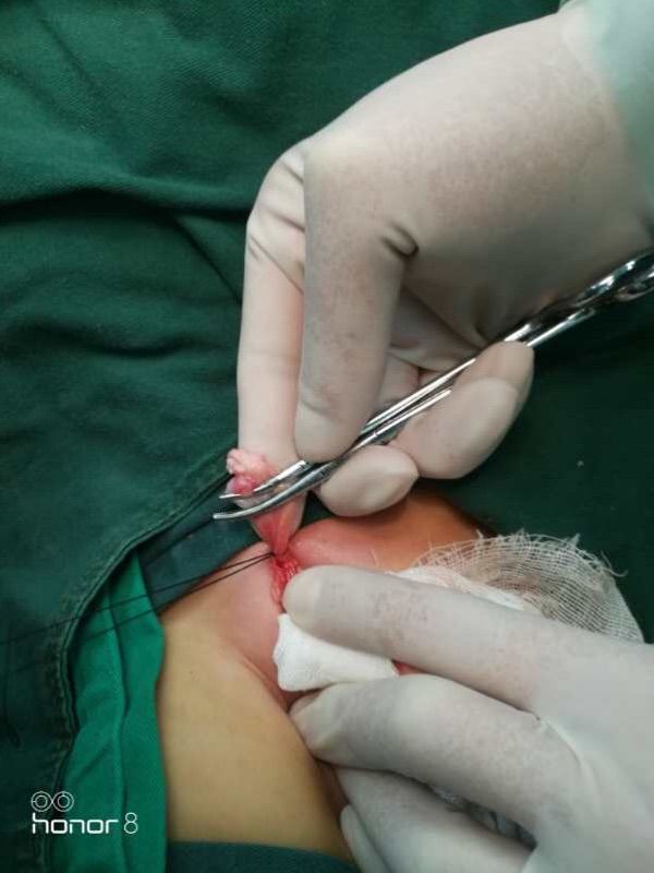 西乡县县医院小儿疝气手术,太和医院疝气微创手术