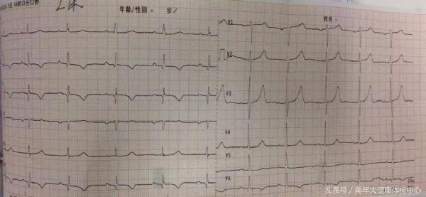 服用华法林患者出现脾脏梗死,服用华法林的案例