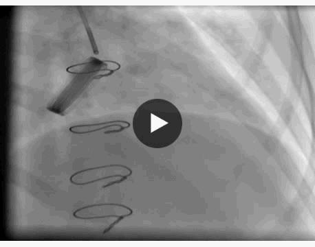 服用华法林患者出现脾脏梗死,服用华法林的案例