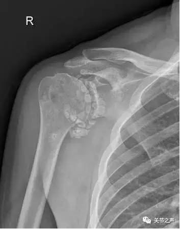 关节腔里长珍珠,关节附近长珍珠