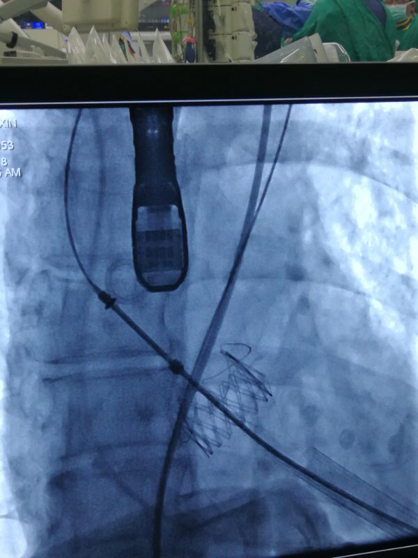 心脏阀门关不严怎么治疗,心脏阀门关不严手术费用
