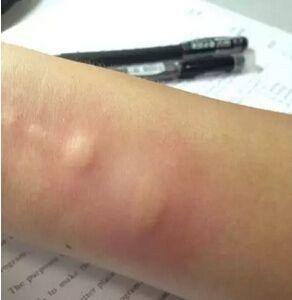 农村有一种叫洋辣子的妖孽，被蛰后用农村土方法比医生说的都管用