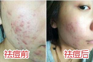 祛除痘印最有效的祛痘神器,祛痘神奇小妙招