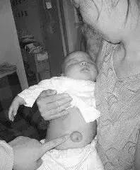 月嫂如何早发现新生儿脐部问题,月嫂给新生儿脐部消毒视频