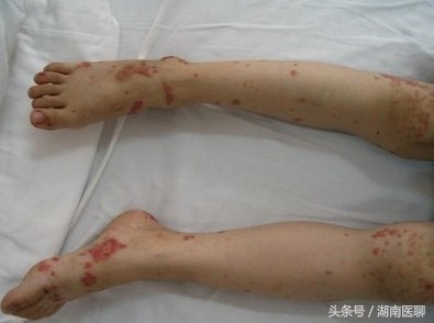 过敏性紫癜真实例子,过敏性紫癜必看的常识