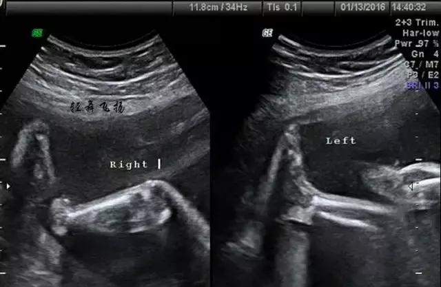 准妈妈看过来孕期瑜伽,孕期b超知识大全