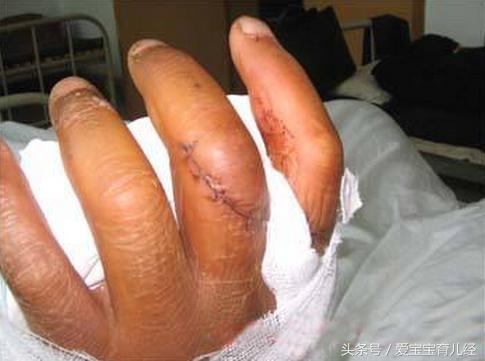 妈妈一时疏忽大意，导致4岁男童3根手指“骨折”！