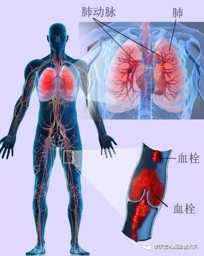 最常引起胸痛的是哪种肺癌,常见致命性胸痛有哪些