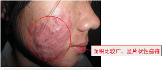 祛除痘印最有效的祛痘神器,祛痘神奇小妙招