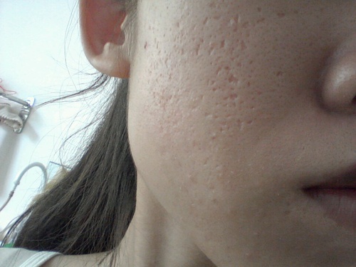 痘印痘坑修复药膏推荐第一名,对痘印有效的护肤品