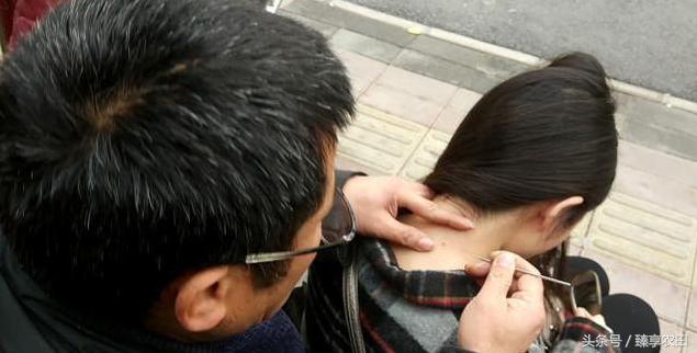 老中医醋精加面粉点痣的视频,男子路边点痣