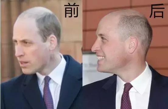37岁威廉王子秃头,威廉王子剃掉光头