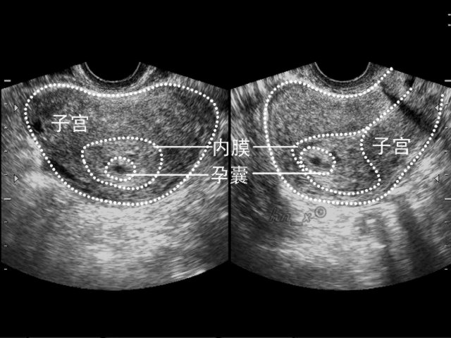准妈妈看过来孕期瑜伽,孕期b超知识大全