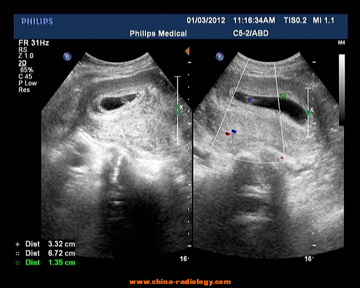 准妈妈看过来孕期瑜伽,孕期b超知识大全