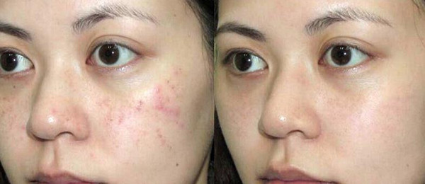 痘印痘坑修复药膏推荐第一名,对痘印有效的护肤品