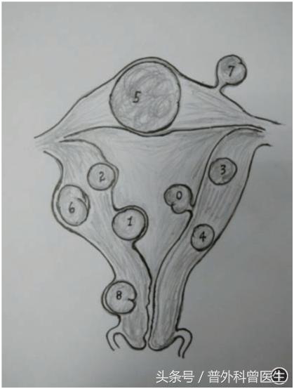 子宫肌瘤中医治疗不用切吗,最新子宫肌瘤手术治疗方法