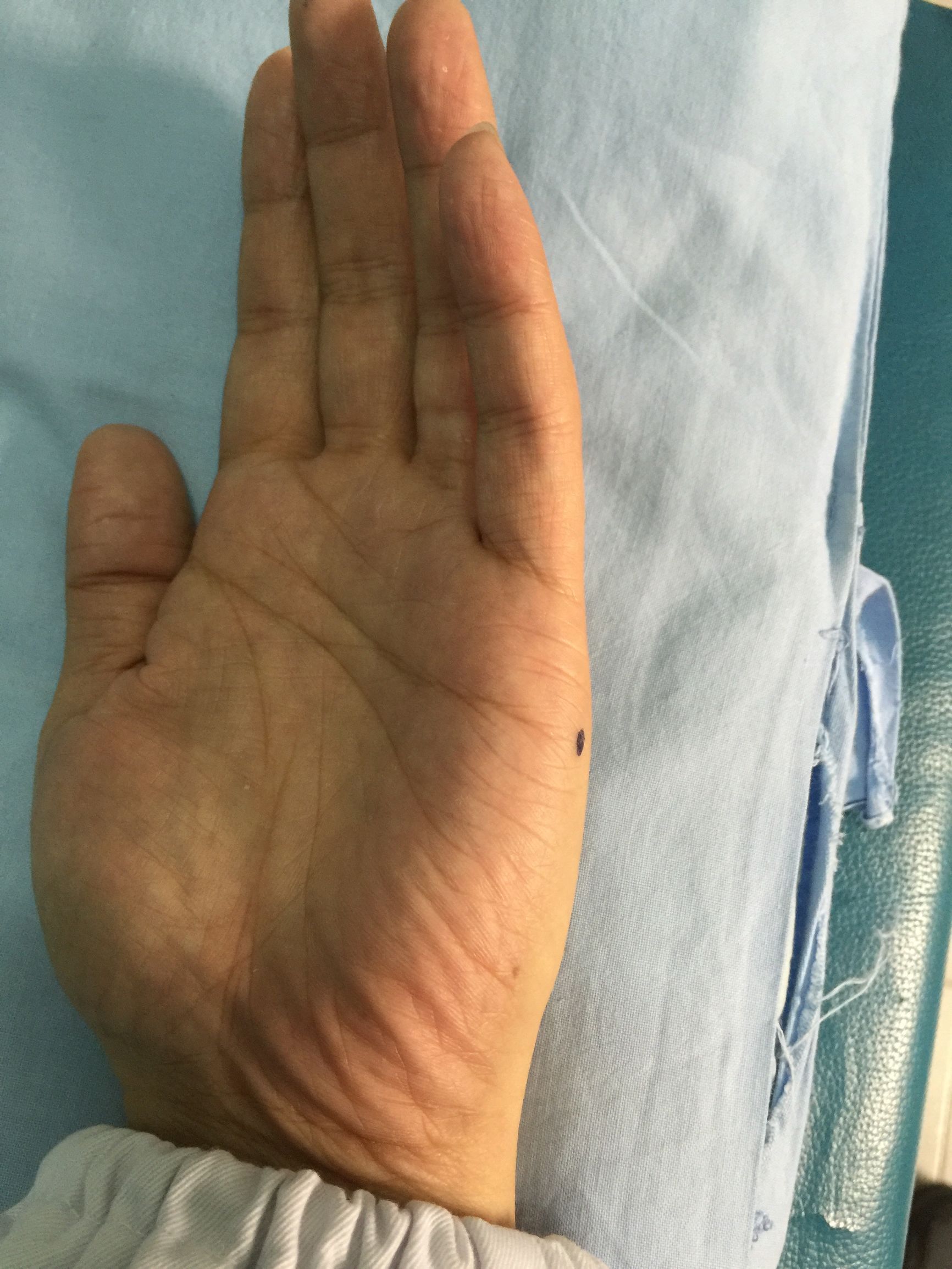 落枕针灸一针见效视频,落枕董氏针灸一针见效