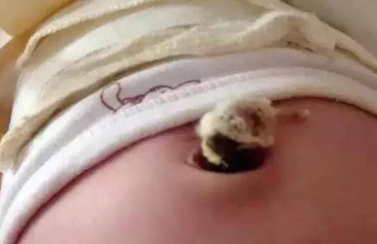 月嫂如何早发现新生儿脐部问题,月嫂给新生儿脐部消毒视频