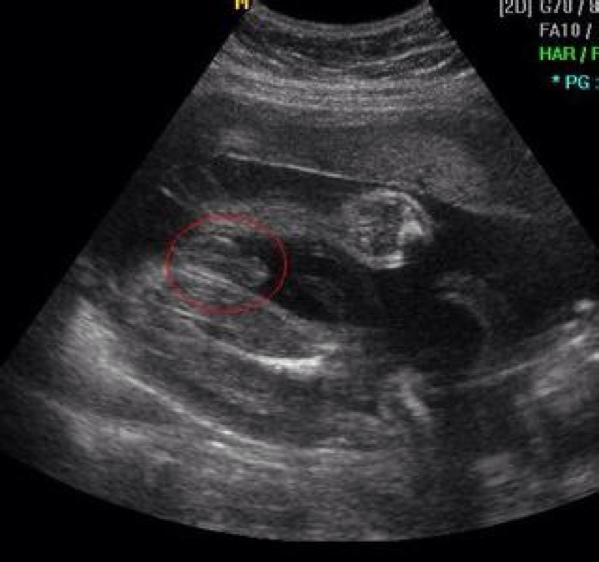 准妈妈看过来孕期瑜伽,孕期b超知识大全