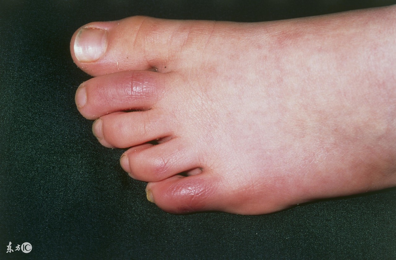 治疗疱疹特效药,痔疮最好的治愈方法是什么