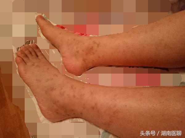 过敏性紫癜真实例子,过敏性紫癜必看的常识