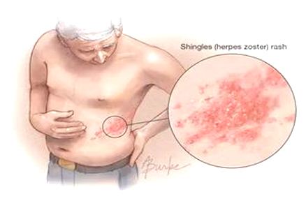 最常引起胸痛的是哪种肺癌,常见致命性胸痛有哪些